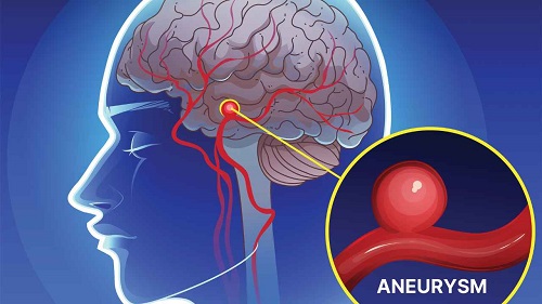 Best Brain Aneurysm Treatment in Chembur